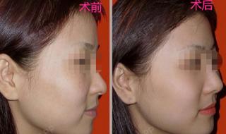 光子嫩肤祛斑多少钱 光子嫩肤祛斑多少钱